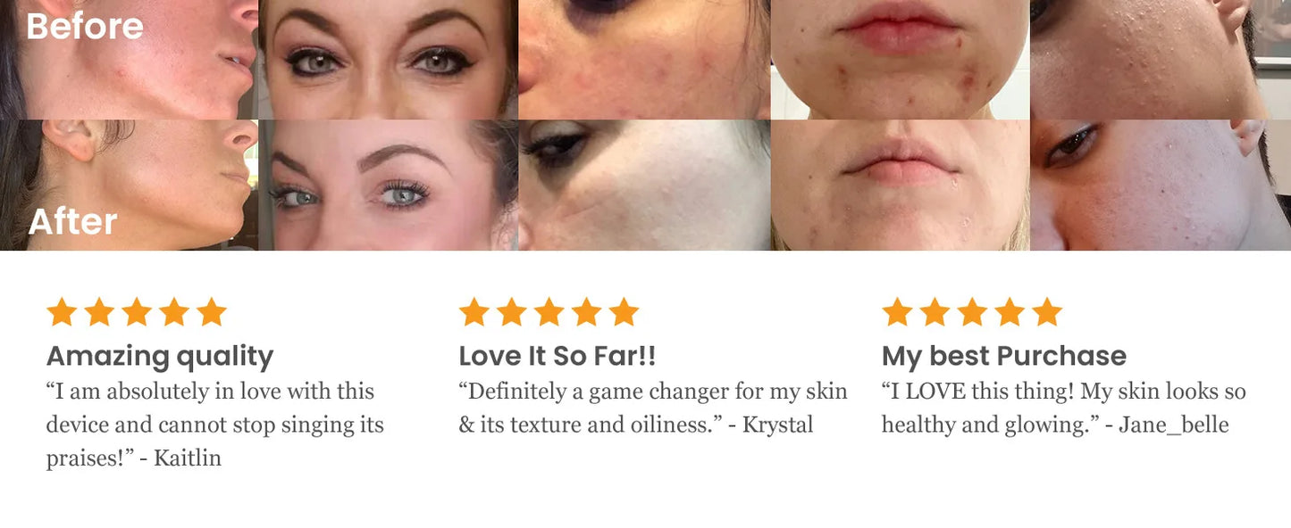 Professional High Frequency Facial Machine Electrotherapy